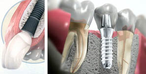 Implantes Dentales - Clínica Dental Sanz&Pancko Barcelona